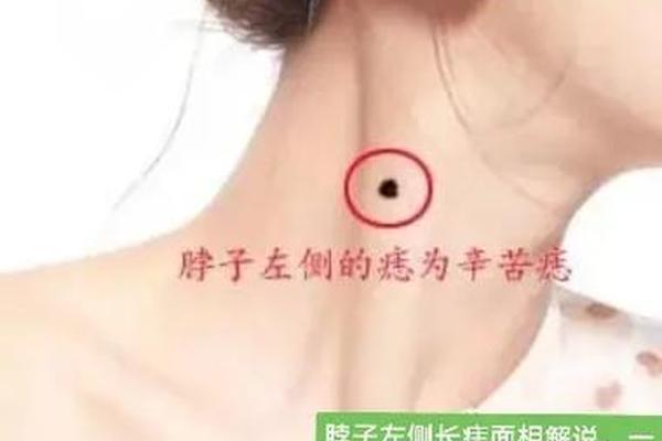 男生左脖子有痣相(脖子痣相图解)