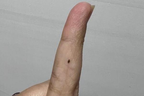 痣相手指 手指有痣意味着什么