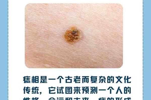 女人右眼皮痣相最准图;面相痣的图片大全